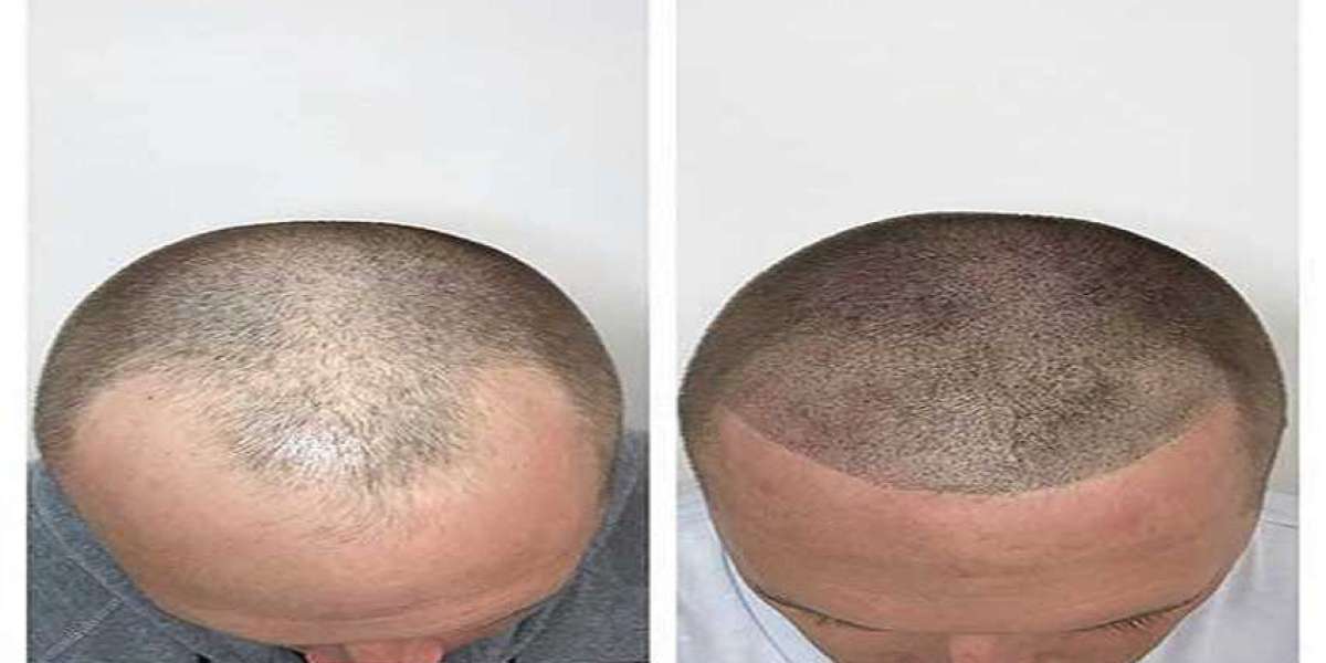 What Is Hair Restoration? Exploring the Role of Trichology Treatments